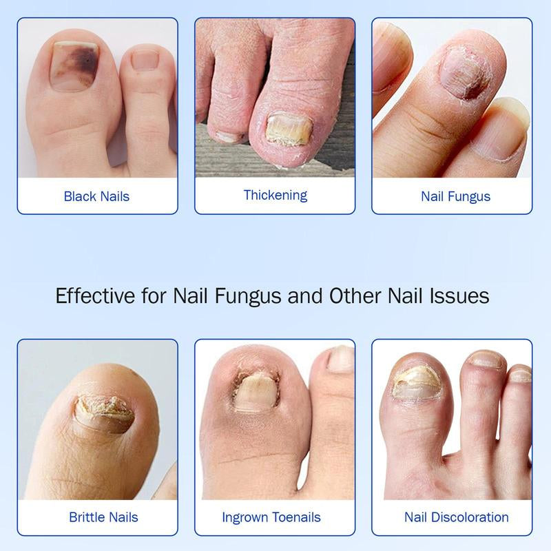 Fungal Nail Patches, Nail Care Patches, Professional Nail Care Product Suitable for Solving Fungal Nails and Other Nail Problems