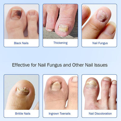 Fungal Nail Patches, Nail Care Patches, Professional Nail Care Product Suitable for Solving Fungal Nails and Other Nail Problems
